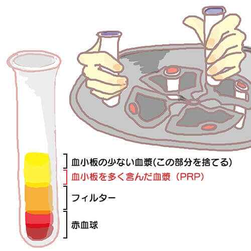 PRP